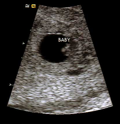 Baby 2 ultrasound
